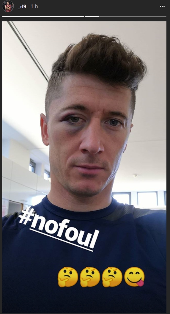 Lewandowski mostró consecuencias del golpe que recibió ante Sevilla