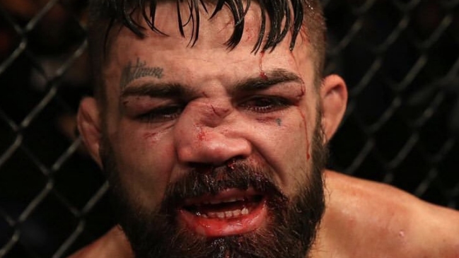 Luchador de UFC sufrió brutal fractura de nariz en Uruguay