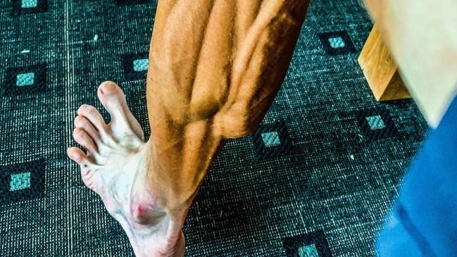 La impactante imagen de las piernas de un ciclista esloveno que volvió a competir tras 10 meses