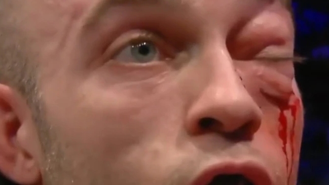 Peleador de MMA quedó con el rostro desfigurado por rodillazo en su debut