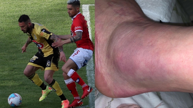 Pinilla mostró su tobillo lastimado y se disculpó por el penal desperdiciado ante Huachipato