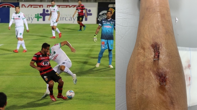 Gabriel Sandoval mostró consecuencias de fuerte infracción de un jugador de Temuco
