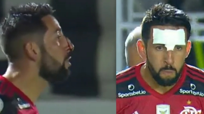 Mauricio Isla recibió un fuerte pisotón en el rostro durante encuentro de Flamengo y Bragantino
