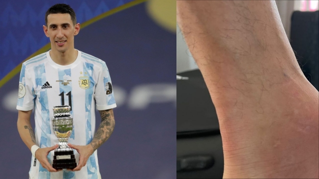 “Así siguió jugando”: Esposa mostró el tobillo de Angel Di María tras la final de Copa América