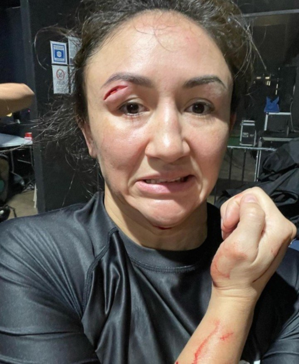 Peleadora de UFC quedó con escalofriante herida en su rostro tras perder su última pelea de 2021