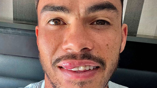 Gabriel Suazo sufrió una fractura dental tras duro choque con Cristian Zavala en entrenamiento