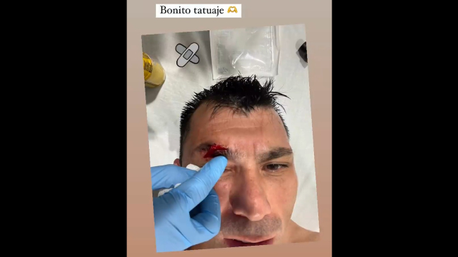 “Bonito tatuaje”: Gary Medel mostró las consecuencias de su choque con Zlatan