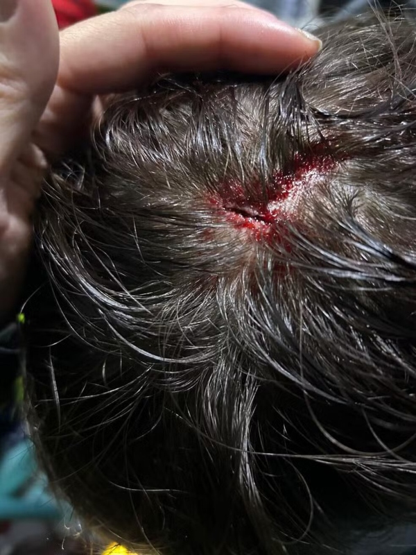 Hincha menor de edad de Fluminense recibió un piedrazo en la cabeza en el Monumental