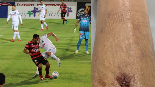 Gabriel Sandoval mostró consecuencias de fuerte infracción de un jugador de Temuco