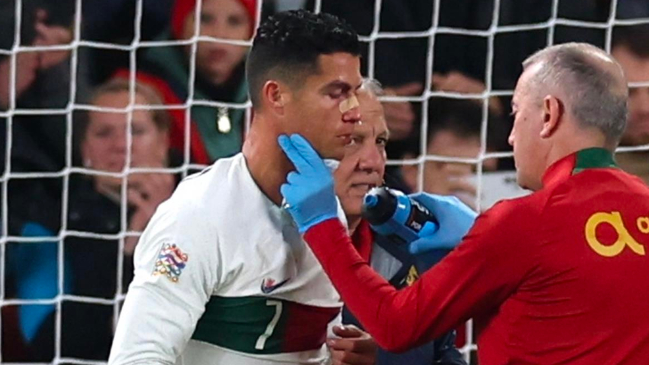 Cristiano Ronaldo sufrió durísimo golpe en la nariz ante República Checa