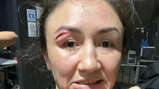 Peleadora de UFC quedó con escalofriante herida en su rostro tras perder su última pelea de 2021