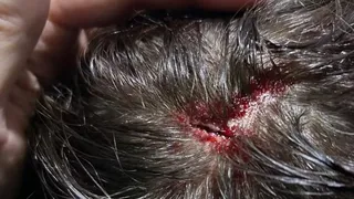 Hincha menor de edad de Fluminense recibió un piedrazo en la cabeza en el Monumental